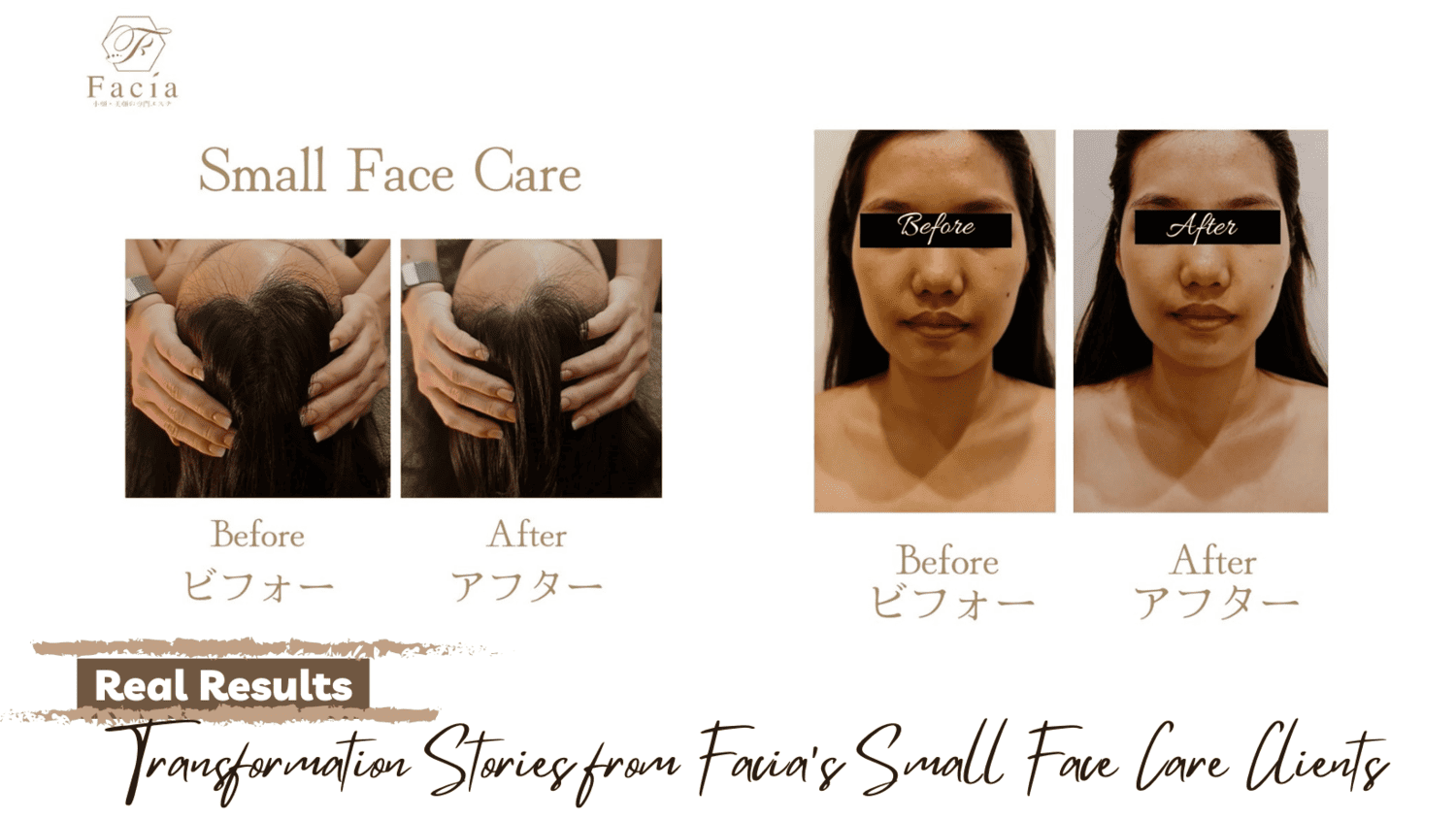 Real Results: Transformation Stories from Facia’s Small Face Care Clients